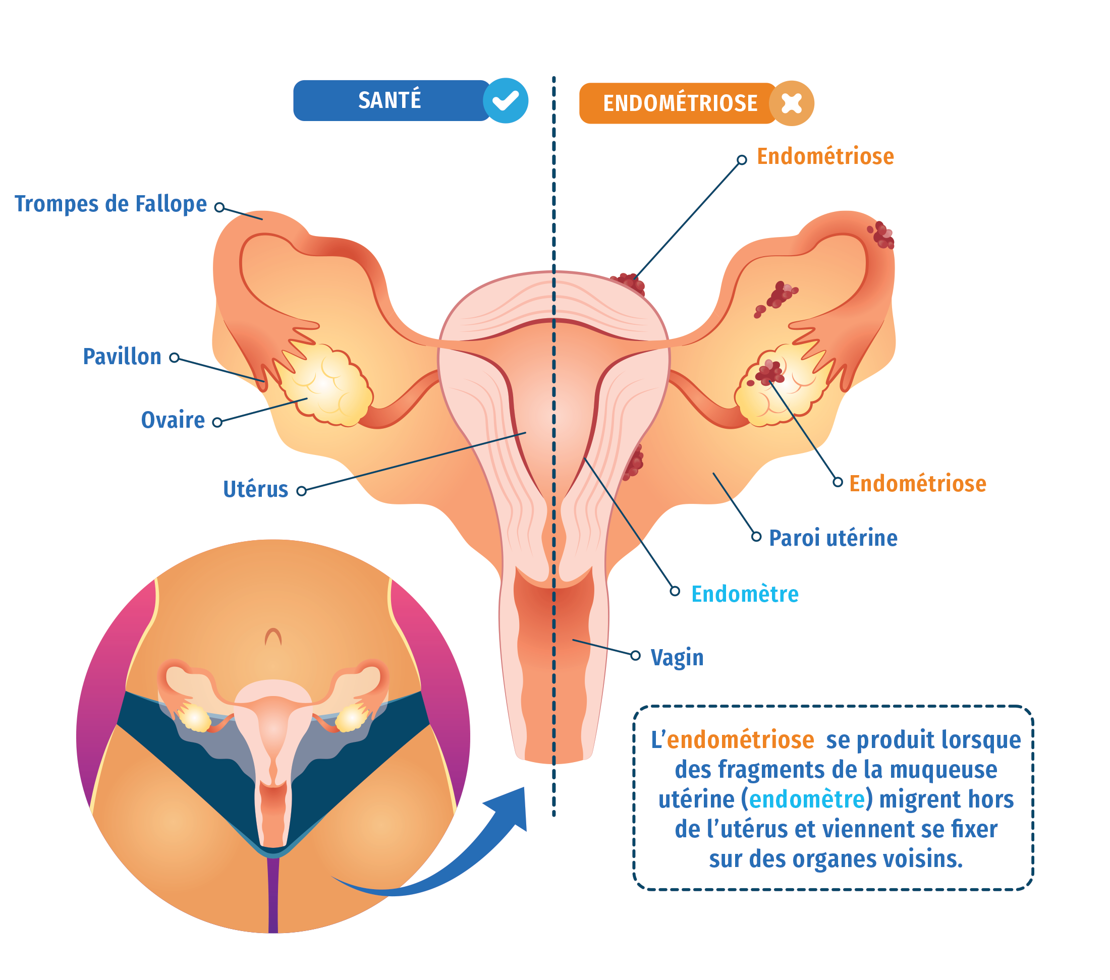 Règles douloureuses et Endométriose