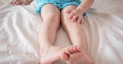 Punaise de lit que faire ?
