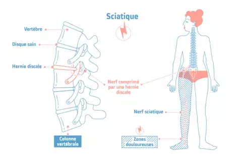 Sciatique, comment se soigner